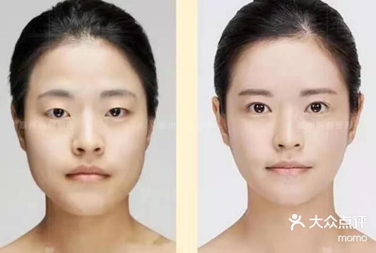 逸美1 1 小金 1,浅层填充