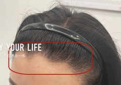 -大麦微针植发全国连锁