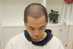 -大麦微针植发丨全国连锁