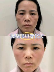 -海涛医疗美容·面部抗衰·注射美鼻