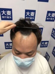 -大麦微针植发丨全国连锁