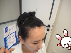 -大麦微针植发丨全国连锁