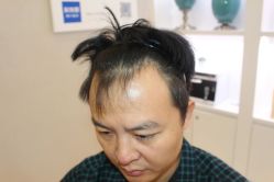 点击看大图 -大麦微针植发丨全国连锁
