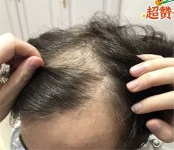 -大麦微针植发全国连锁