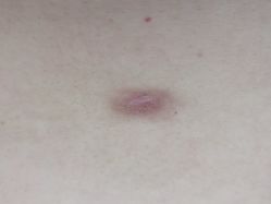 -成都军建医院·疤痕诊疗中心