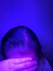 -大麦微针植发丨全国连锁