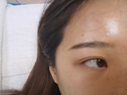 体验前-JUVA郑州欧华医疗美容医院