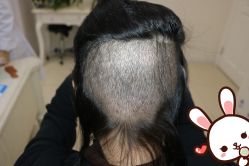 点击看大图 -大麦微针植发丨全国连锁