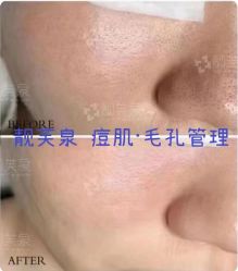 -靓芙泉祛痘.科技美肤连锁