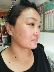 -北京美痣堂古方祛痣斑疣瘊