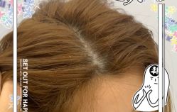 -大麦微针植发全国连锁