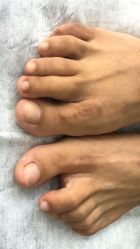 -德哥灰指甲脚气甲沟炎跖疣护理