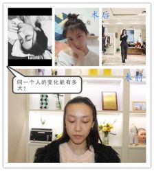 -大麦微针植发全国连锁