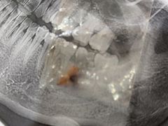 -上海仁爱医院口腔科 · 种植