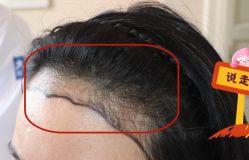 -大麦微针植发全国连锁