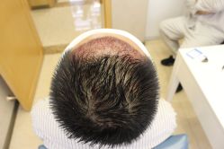 -大麦微针植发丨全国连锁