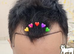 -大麦微针植发全国连锁