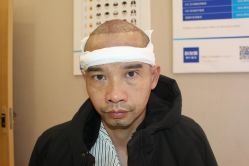 -大麦微针植发丨全国连锁