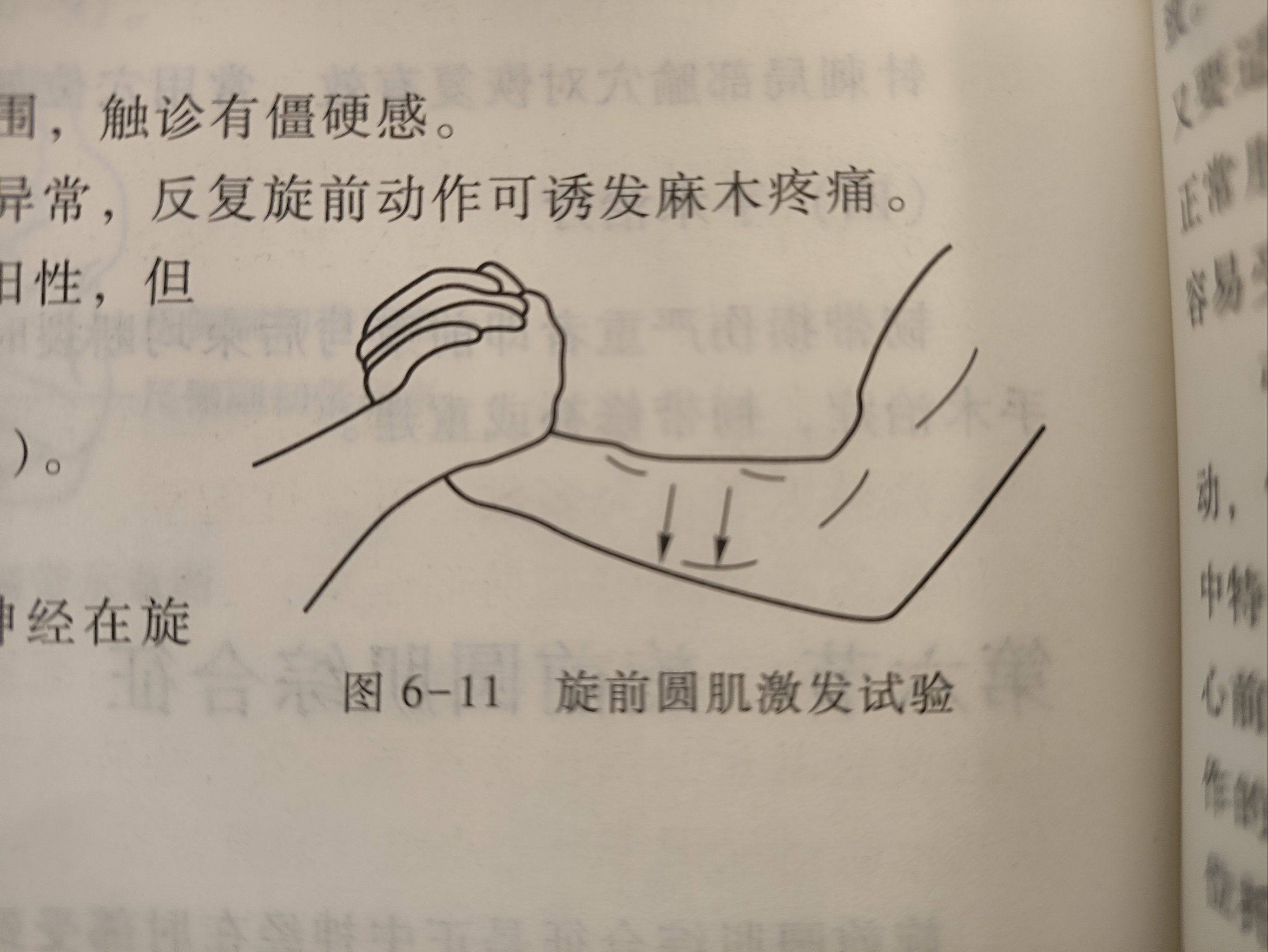 旋前圆肌综合征,是由于正中神经在旋前圆肌