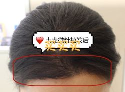 -大麦微针植发全国连锁