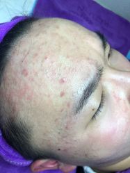 -蕾特恩祛痘•皮肤管理