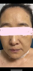 -美丽人生祛斑扁平疣汗管瘤中心