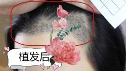 -大麦微针植发全国连锁