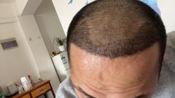 体验后-大麦微针植发丨全国连锁