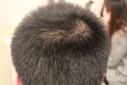 点击看大图 -大麦微针植发丨全国连锁