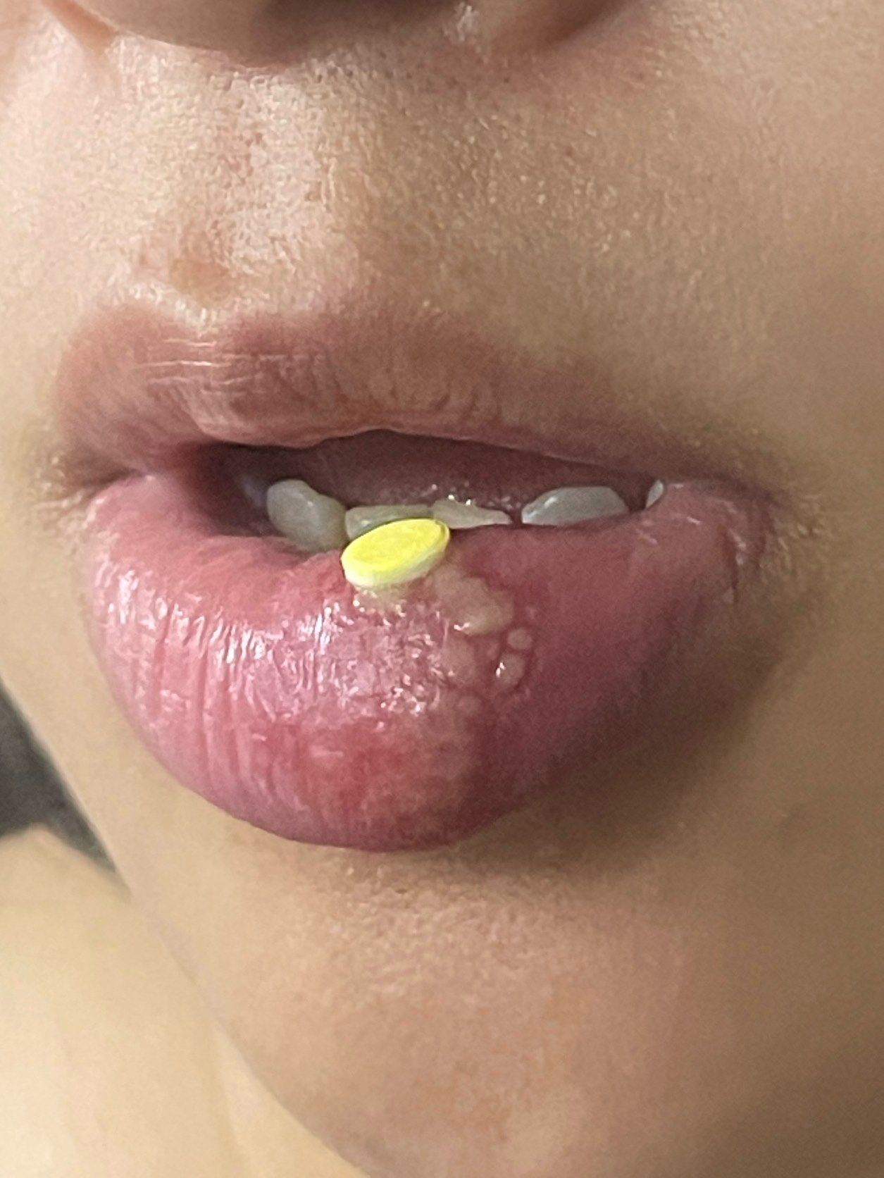 口腔溃疡怎么还会"繁殖"啊?