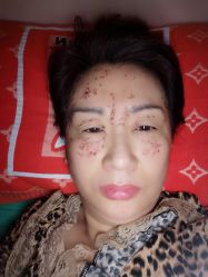 体验后-美丽人生祛斑扁平疣汗管瘤中心