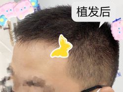 -大麦微针植发全国连锁