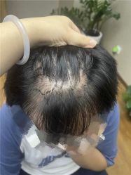 体验前-大麦微针植发全国连锁