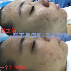 -靓芙泉祛痘.科技美肤连锁
