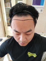 点击看大图 -大麦微针植发全国连锁