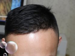 -大麦微针植发丨全国连锁