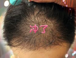 -大麦微针植发全国连锁