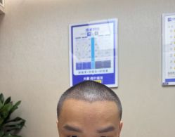 -大麦微针植发全国连锁