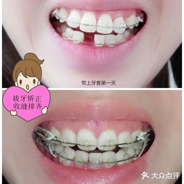 矫正牙齿担心的问题有很多，别担心都有答案！