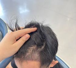 -大麦微针植发全国连锁