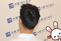 点击看大图 -大麦微针植发丨全国连锁