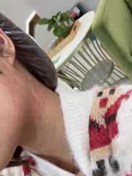 体验后-郡艺医疗美容·微整·眼鼻吸脂