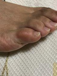 -德哥灰指甲脚气甲沟炎跖疣护理