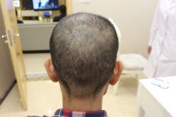 -大麦微针植发丨全国连锁