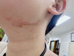 -杭州仁易堂中医康复医院疤痕修复