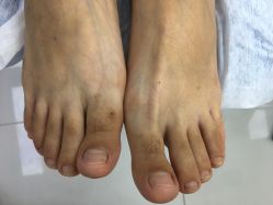 点击看大图 -派恩宜灰指甲鸡眼嵌甲手足癣