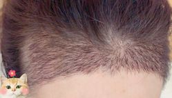 -大麦微针植发丨全国连锁