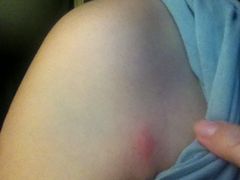 一家三口均被跳蚤咬了无数口-屋顶顶城市·江景酒店-客房部