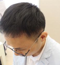 -大麦微针植发全国连锁