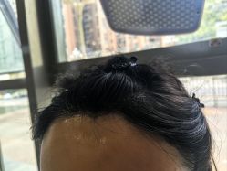 -碧莲盛·不剃发植发